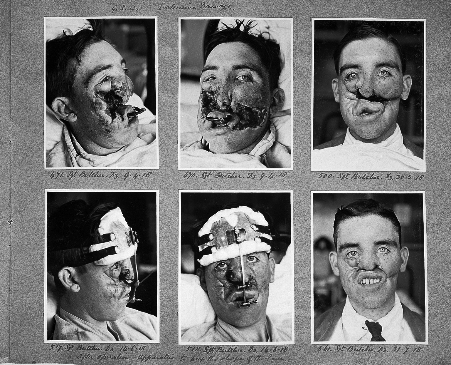 Sgt Butcher - WW1 - plastic surgery